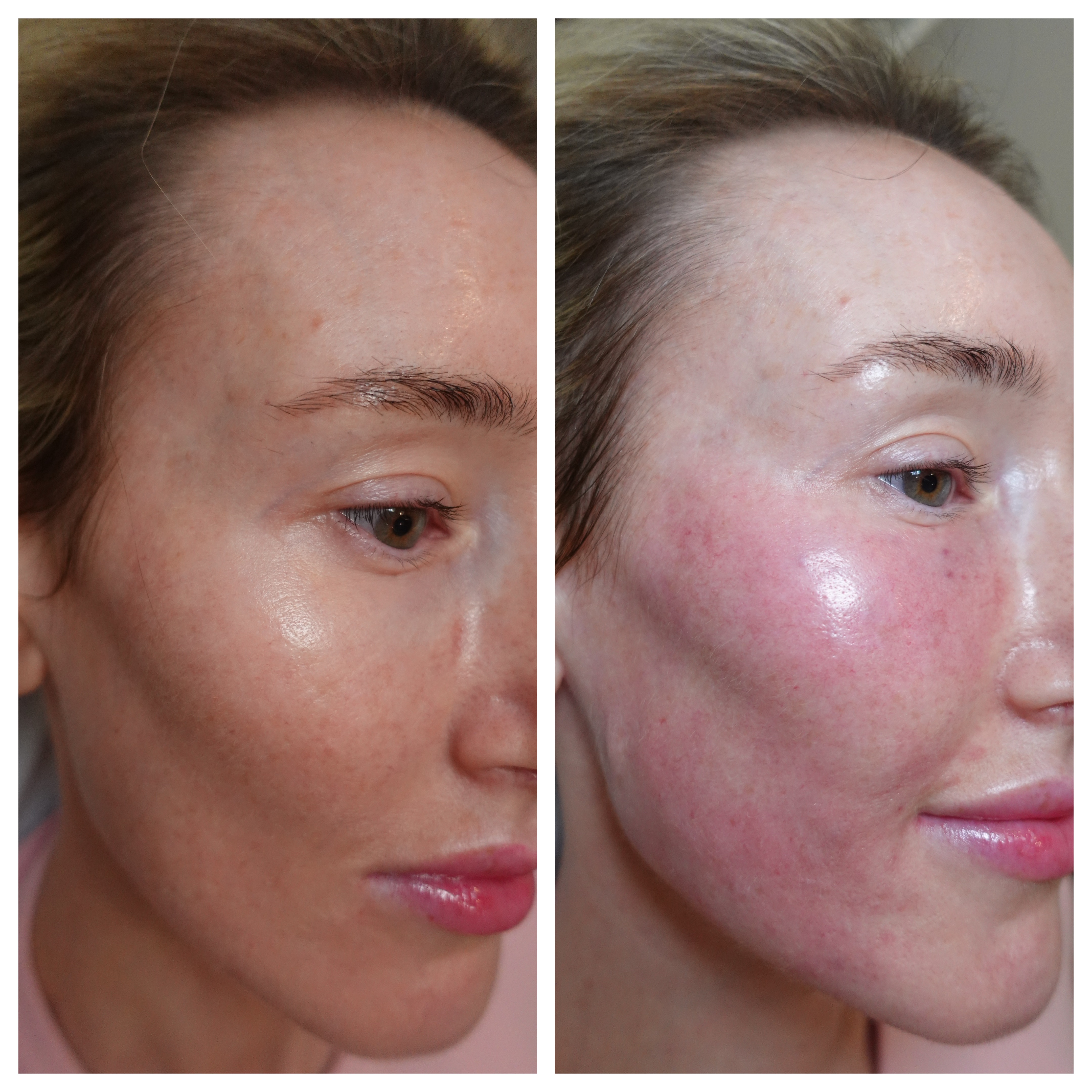Profhilo treatment result, Fulham clinic
