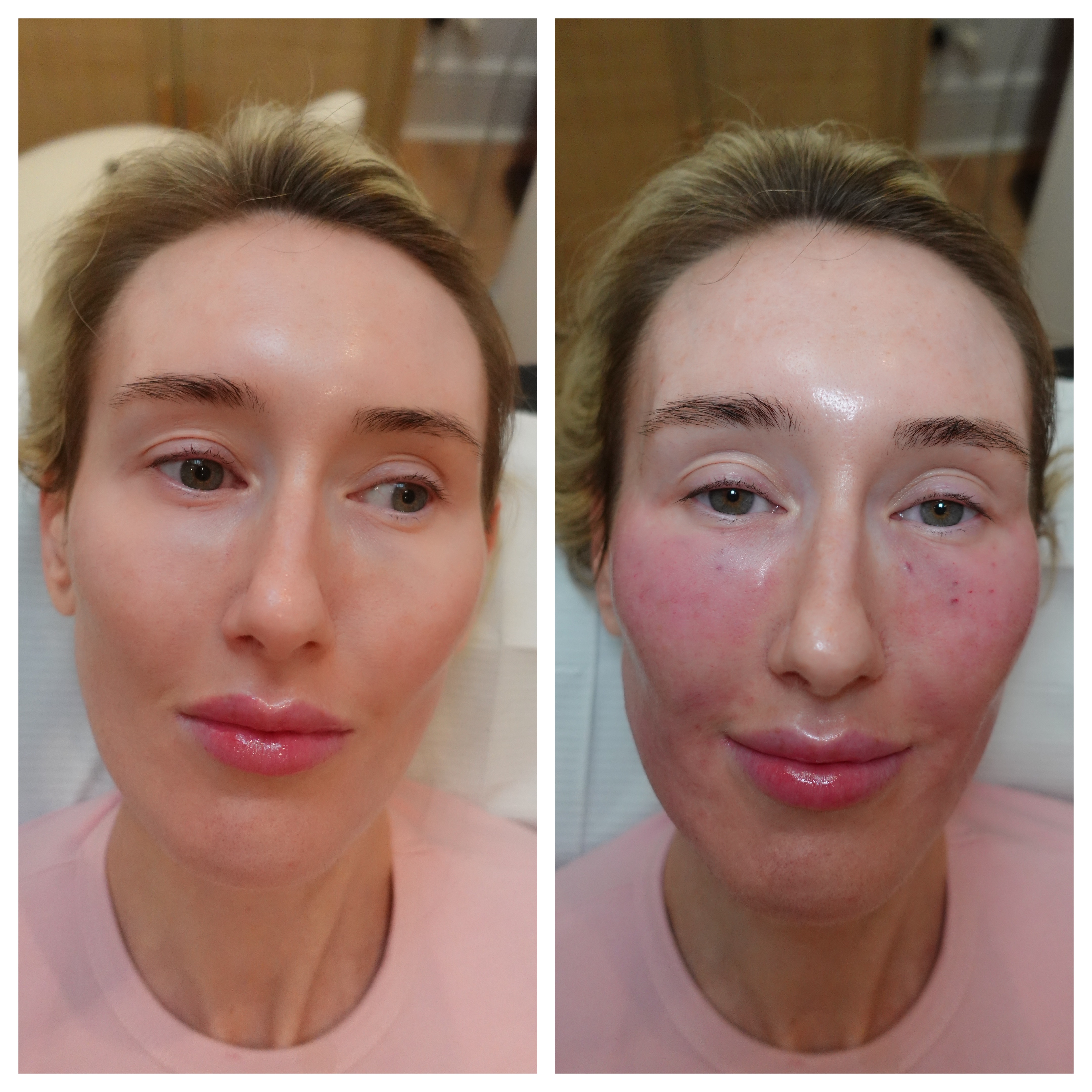 Profhilo treatment result, Fulham clinic