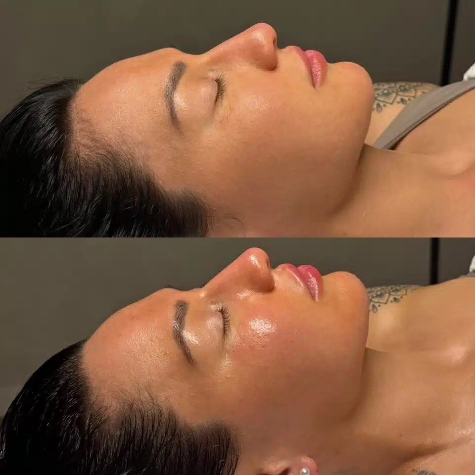 Facial sculpting lymphatic drainage treatment London