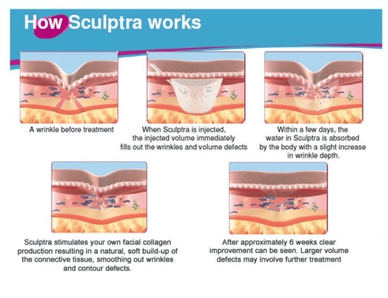 How Sculptra works