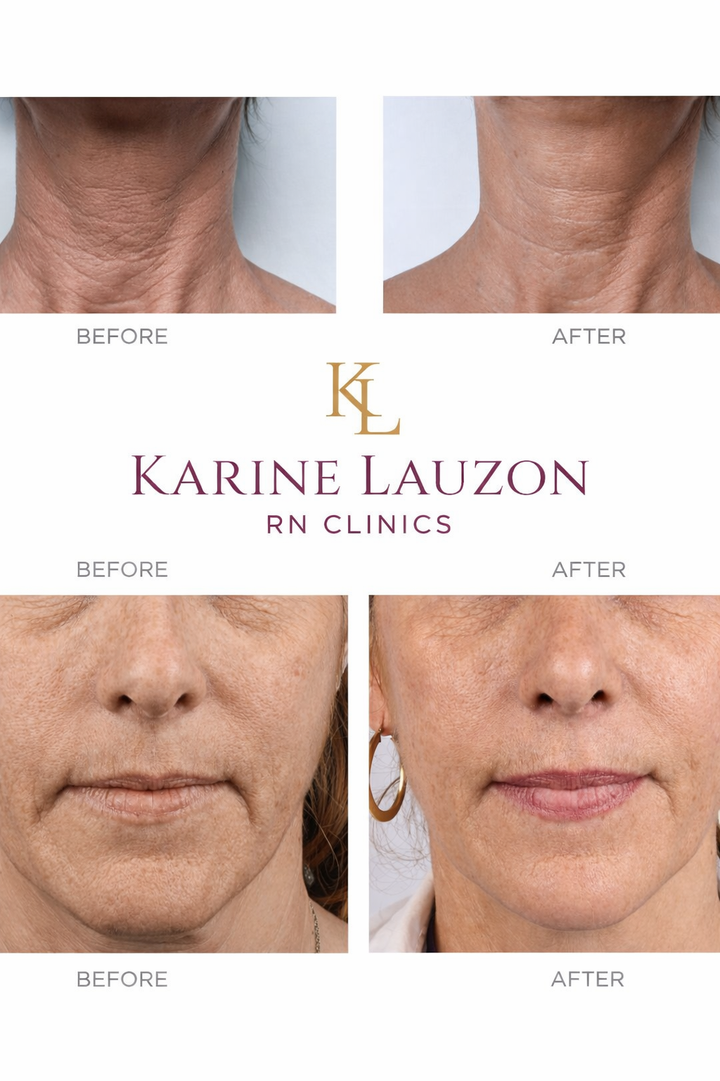 Baby Glow Before and After Results - Neck and Face