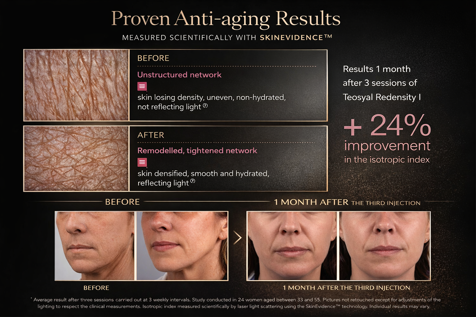 Proven Anti-aging Results - Teosyal Redensity 1 - 24% improvement in isotropic index after 3 sessions