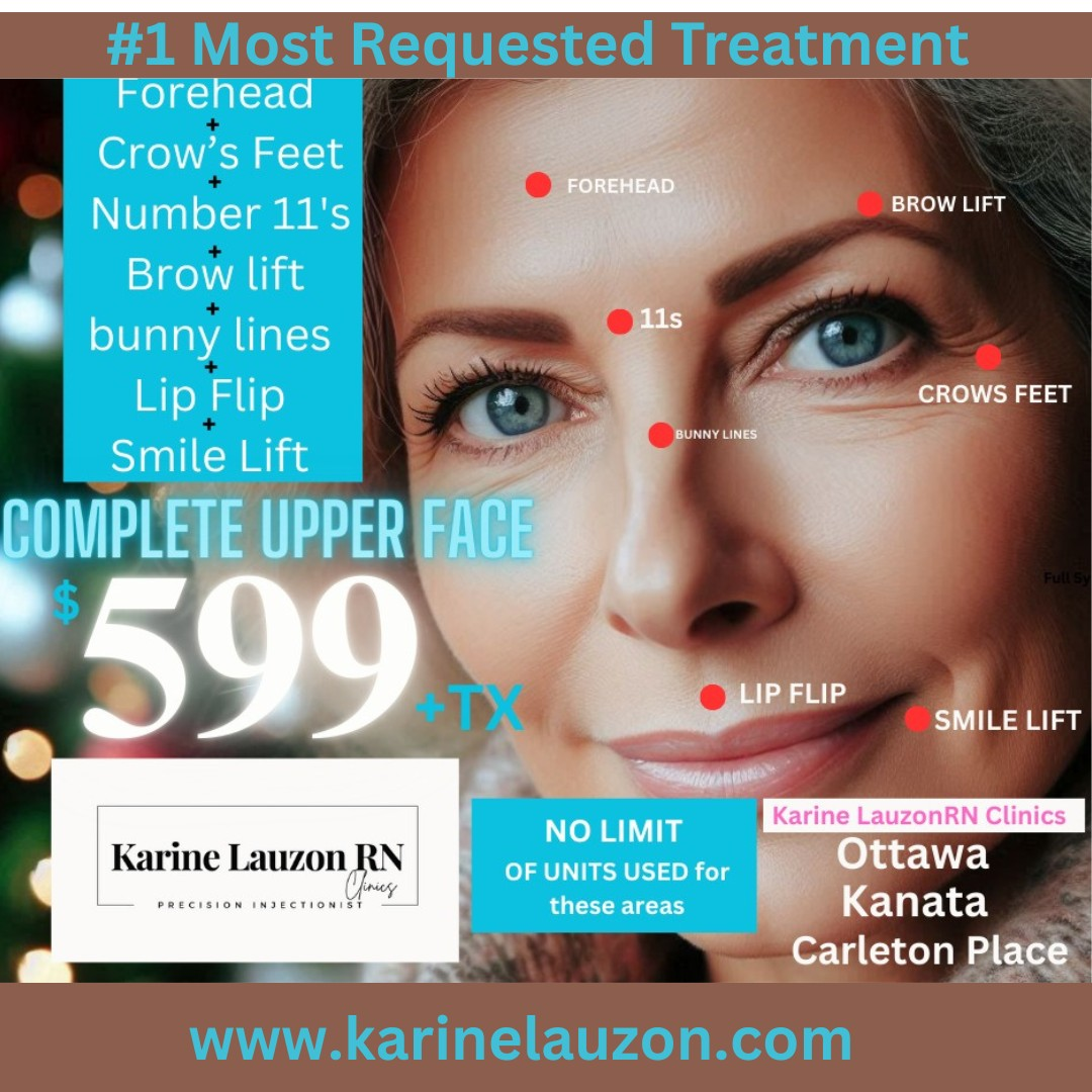 Complete Upper Face Treatment - $599