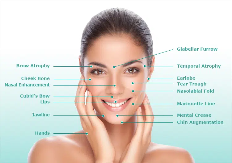 Sculptra treatment areas