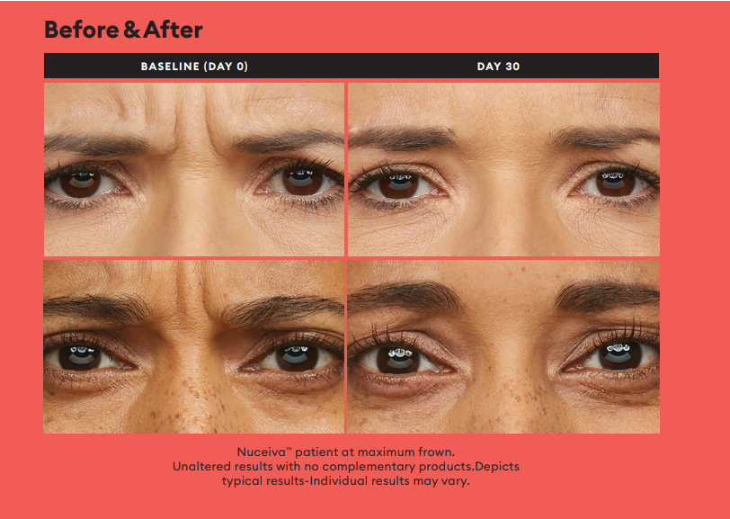 Botox Before and After Results