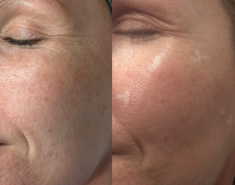 Profhilo before and after skin quality, Fulham clinic