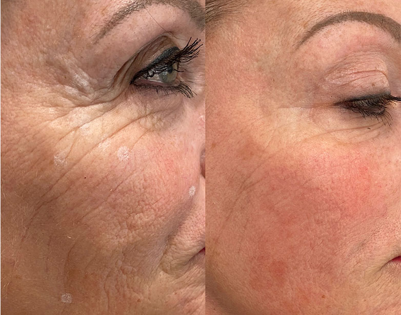 Profhilo before and after result, Fulham clinic