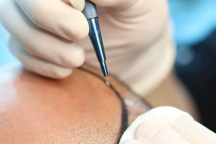 Saphir FUE Haartransplantation Methode - Dion Hair Clinic