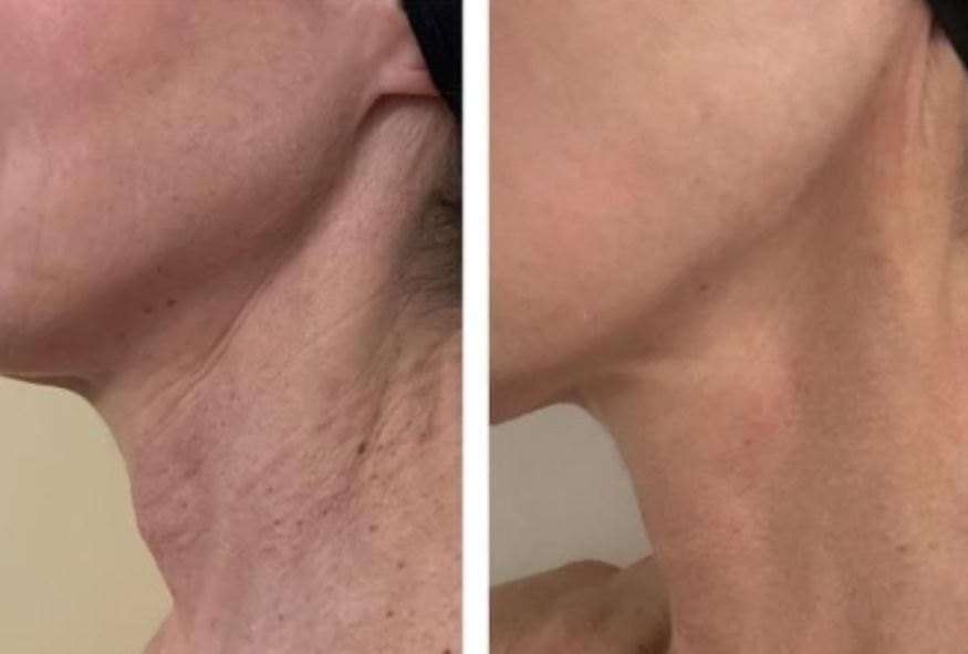 Polynucleotide treatment before and after - neck skin tightening