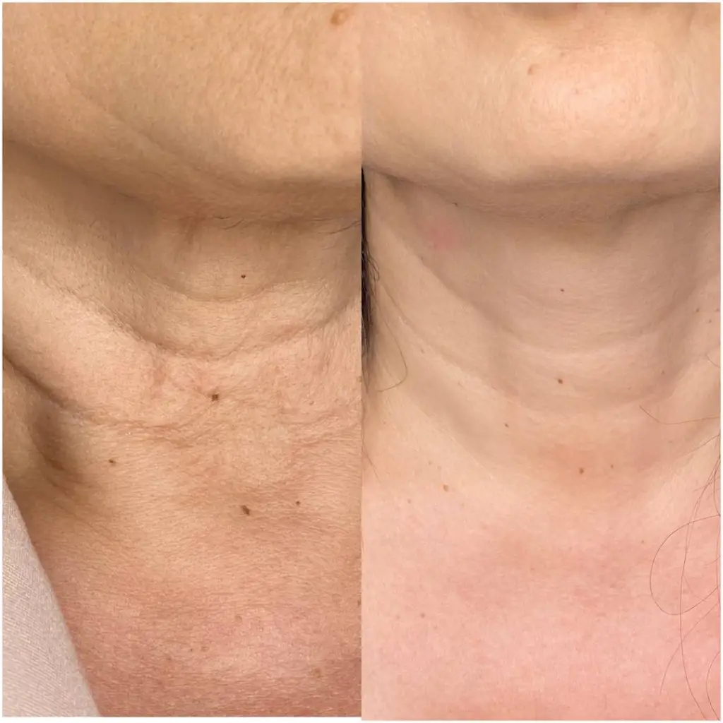 Profhilo neck rejuvenation before and after