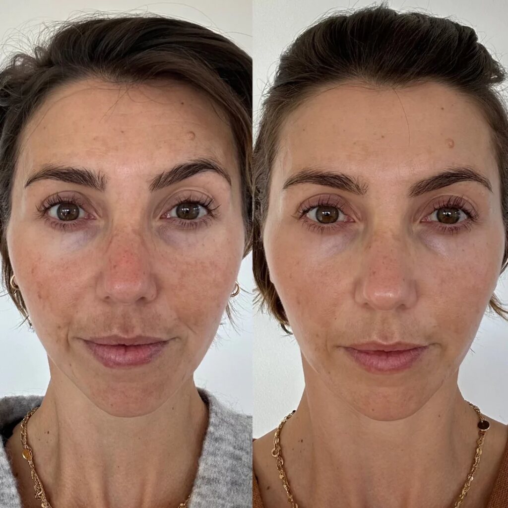 Microneedling with exosomes before and after showing improved skin texture and reduced hyperpigmentation in Fulham London