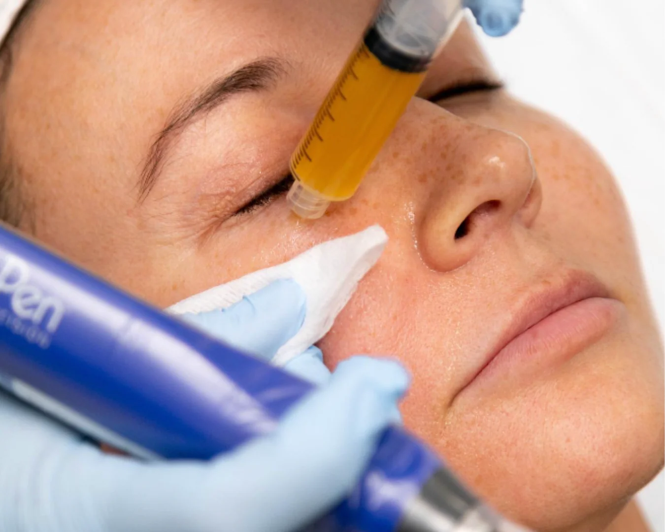 Medical microneedling with PRP serum treatment
