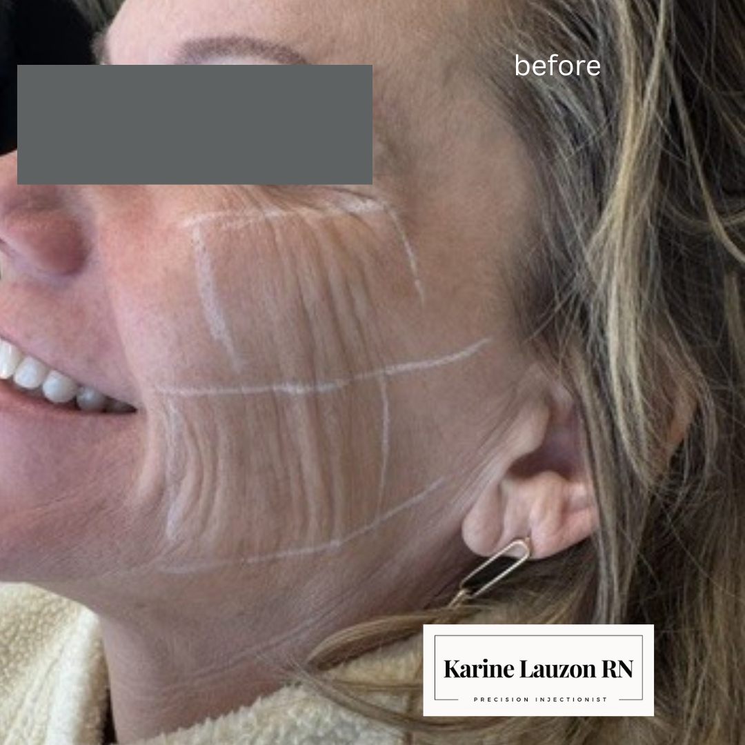 Before treatment - side profile showing skin texture