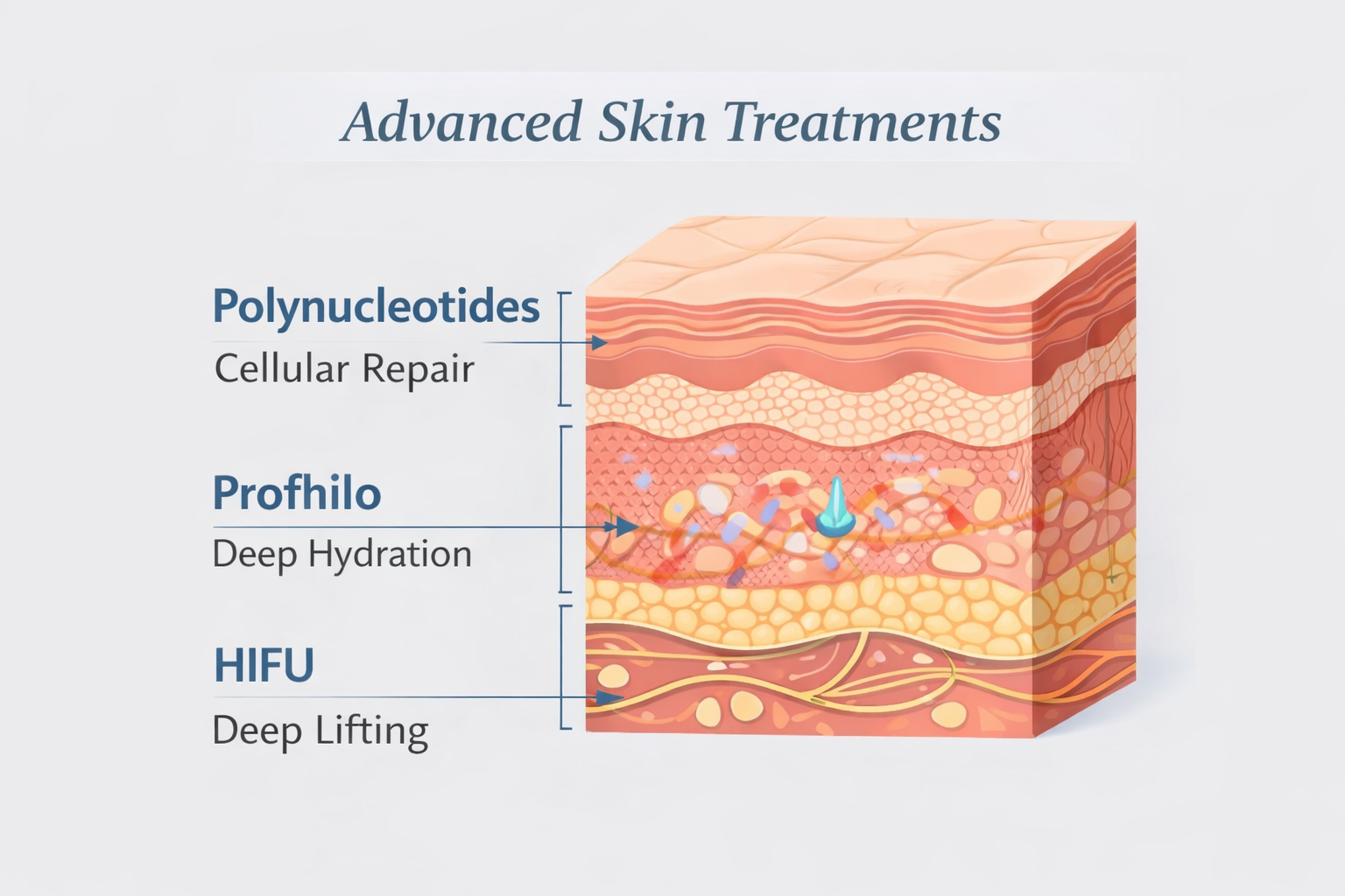 Advanced skin treatments diagram showing treatment depths: polynucleotides for cellular repair at the upper dermis, Profhilo for deep hydration in the mid dermis, and HIFU for deep lifting at the SMAS layer