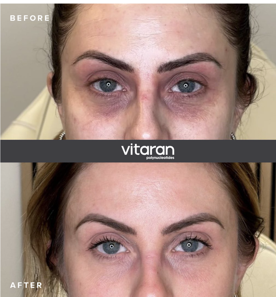 Vitaran Eyes under-eye regeneration before and after, Fulham London Vitaran polynucleotides under eye before and after regeneration result Fulham London