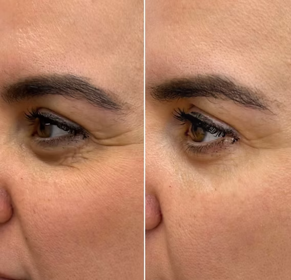 Exosome microneedling treatment South West London for skin quality and regeneration
