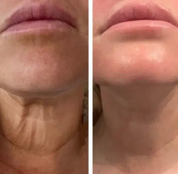 Polynucleotide treatment result Fulham London: regenerative skin and neck rejuvenation before and after