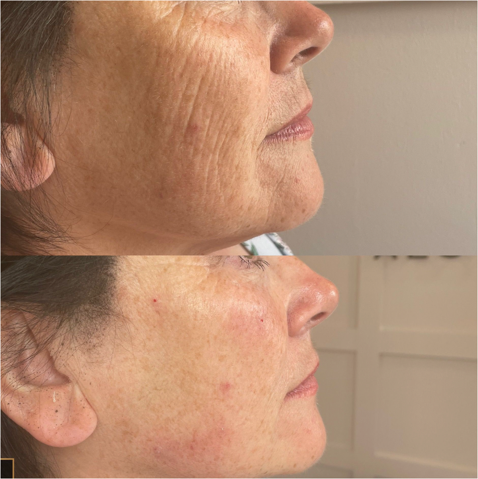 Polynucleotide before and after, Fulham London Polynucleotide skin regeneration before and after Georgina Sookias