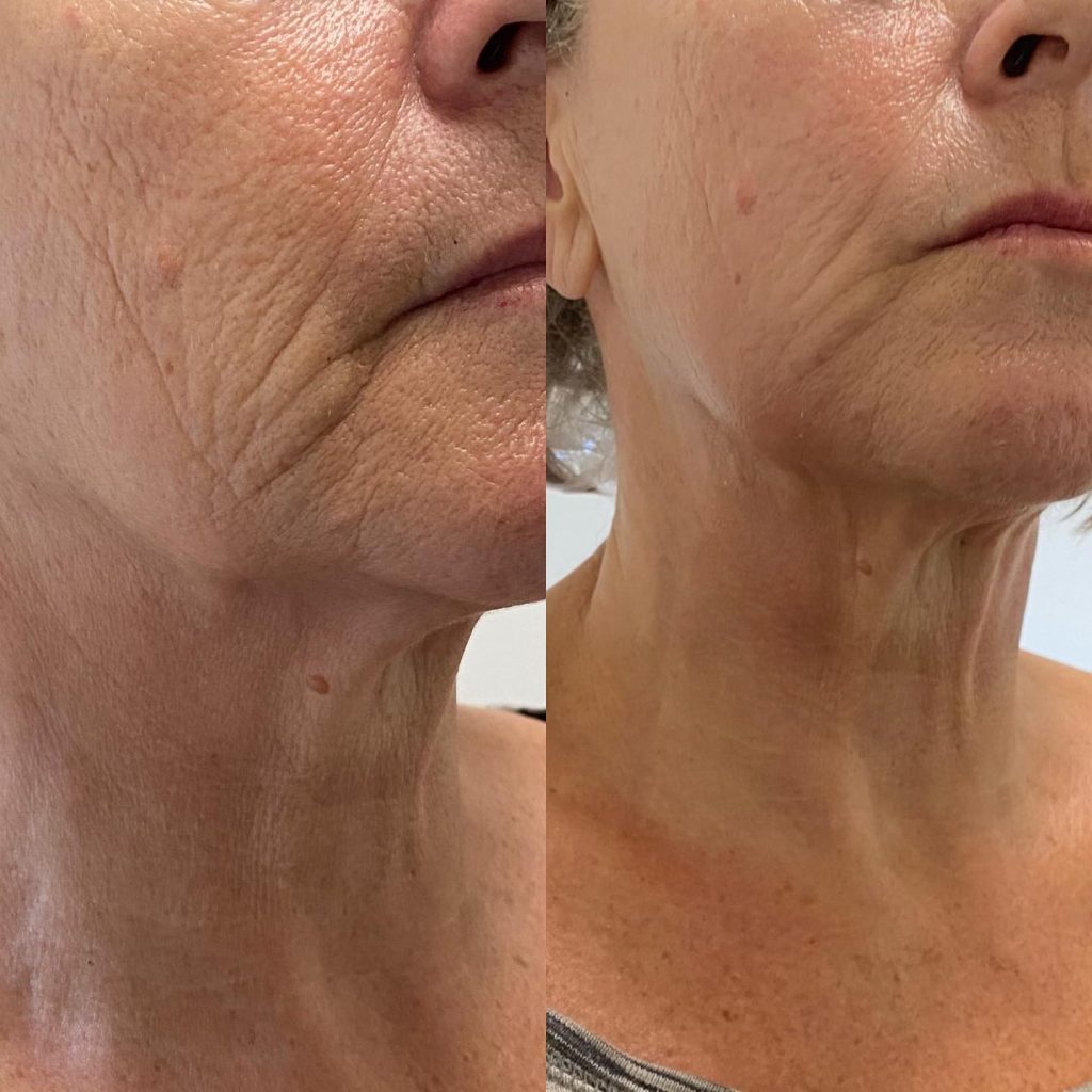 HIFU before and after results showing jawline and neck tightening from Ultraformer III treatment in Fulham, London