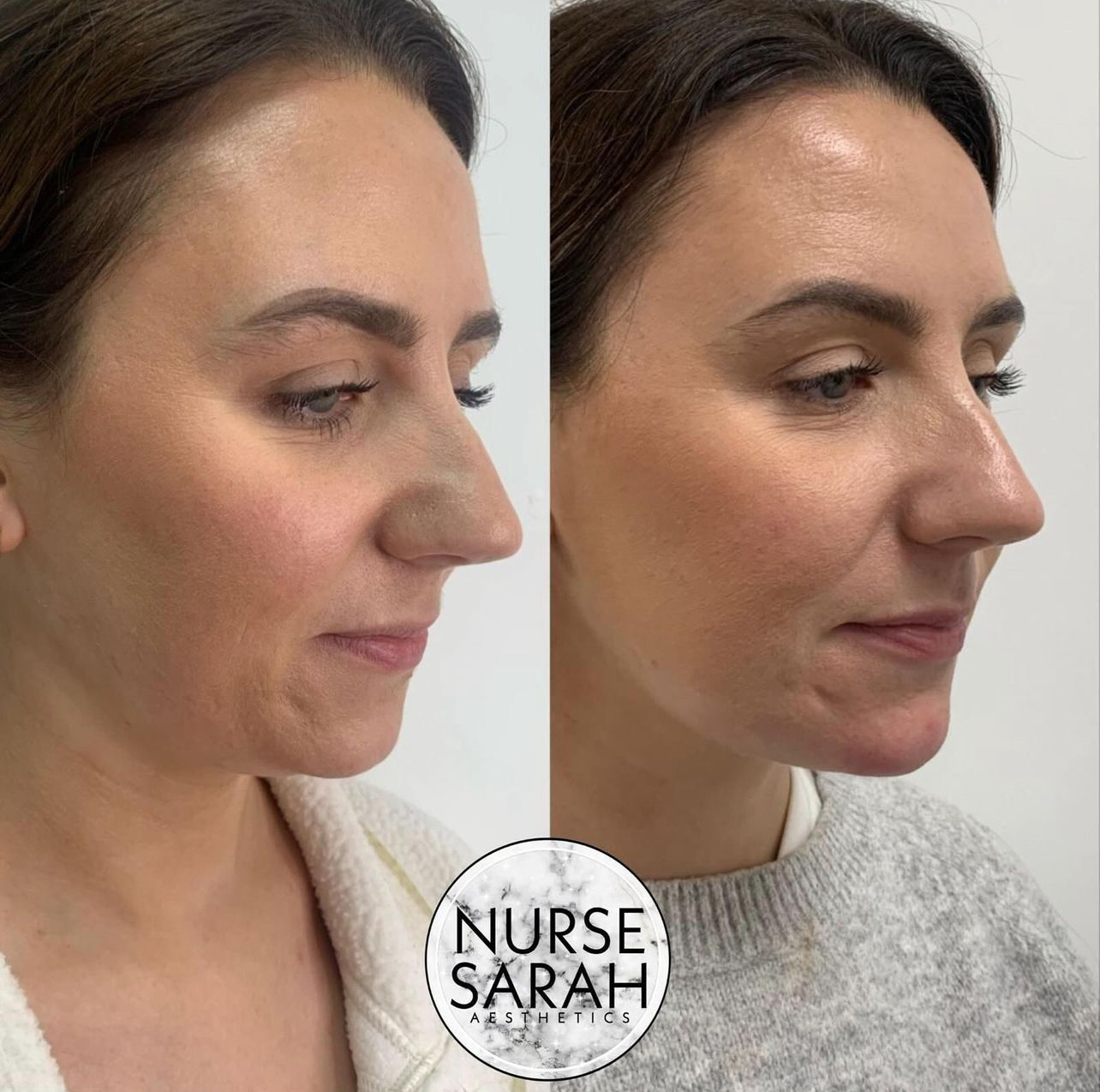 Jawline Contouring