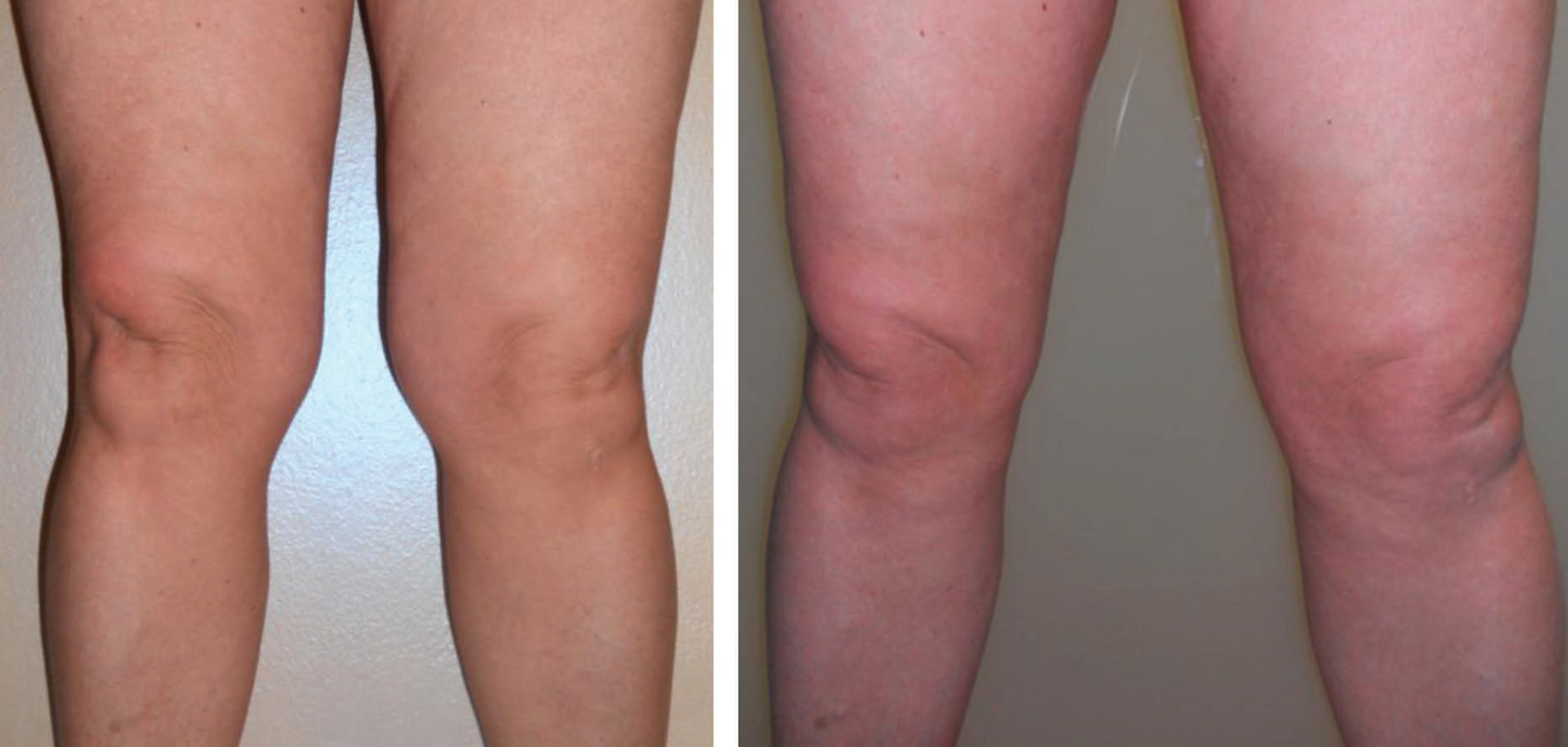 Inner Knee Contouring