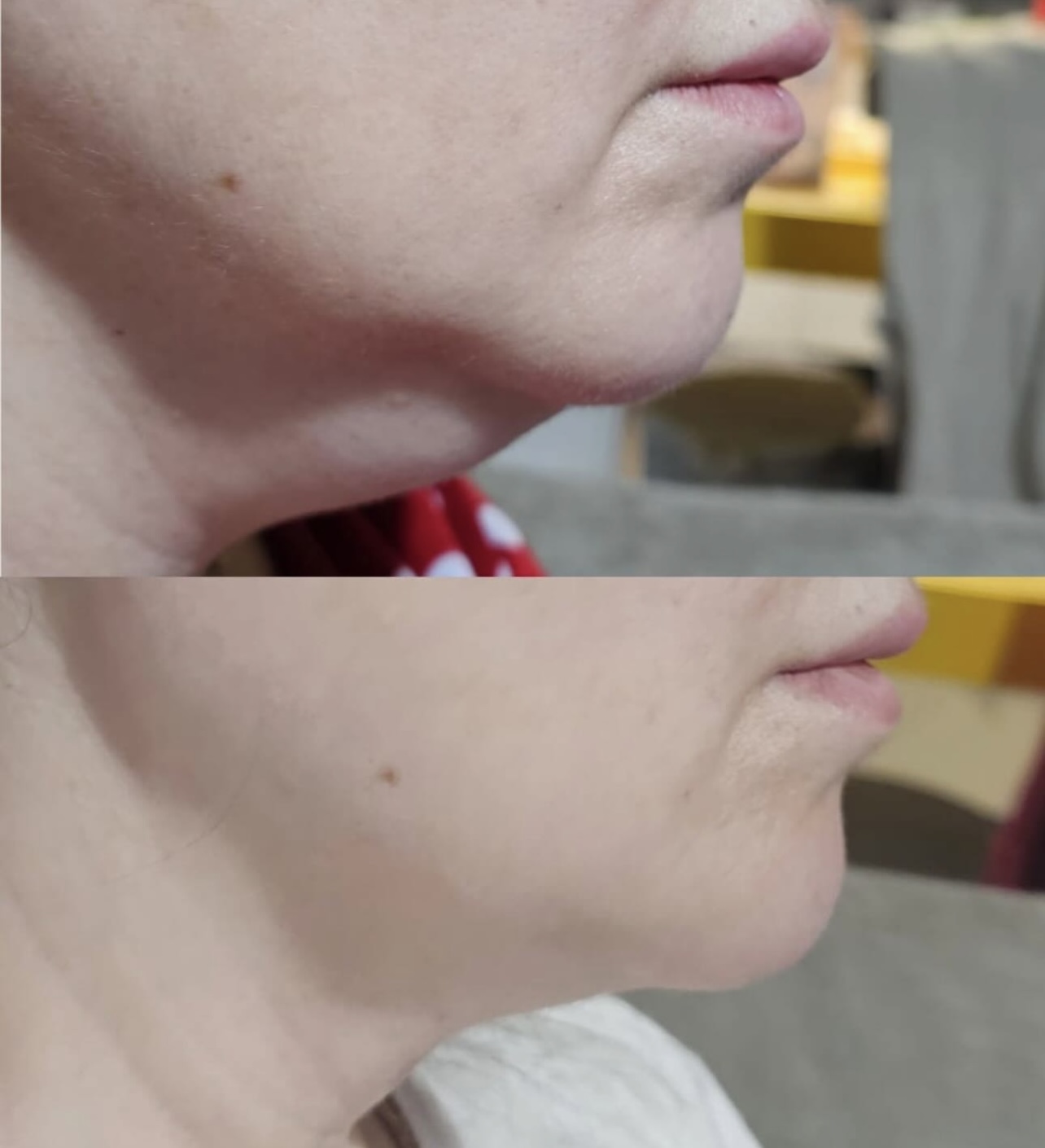 Double Chin Contouring