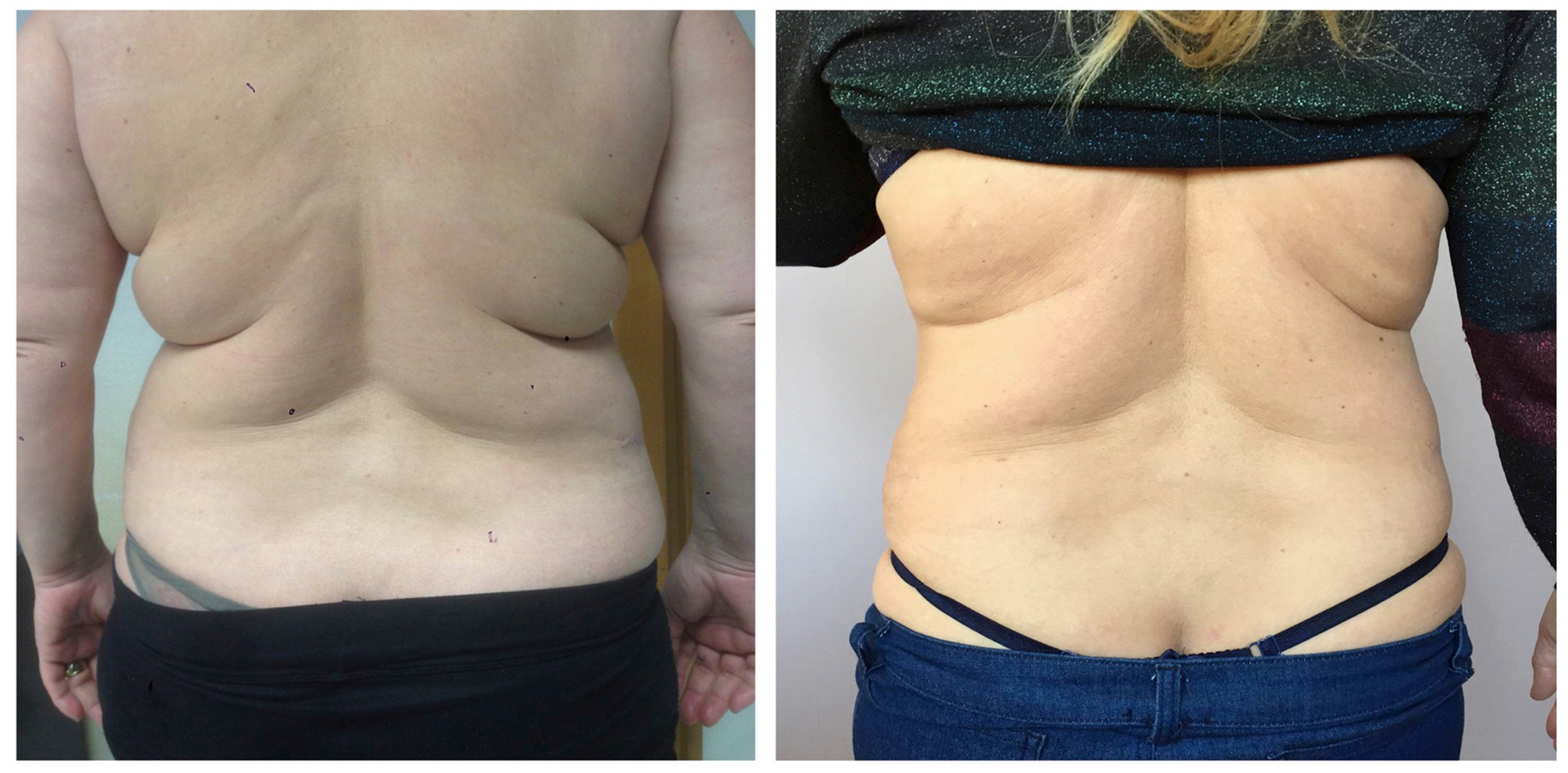 Chest Fold Contouring