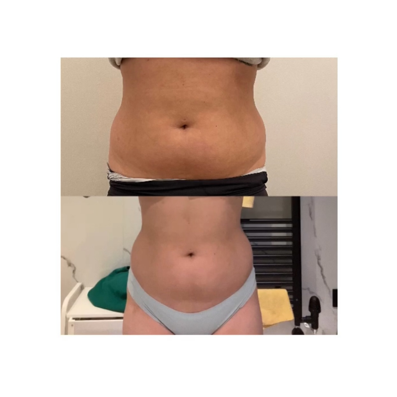 Abdominal Contouring