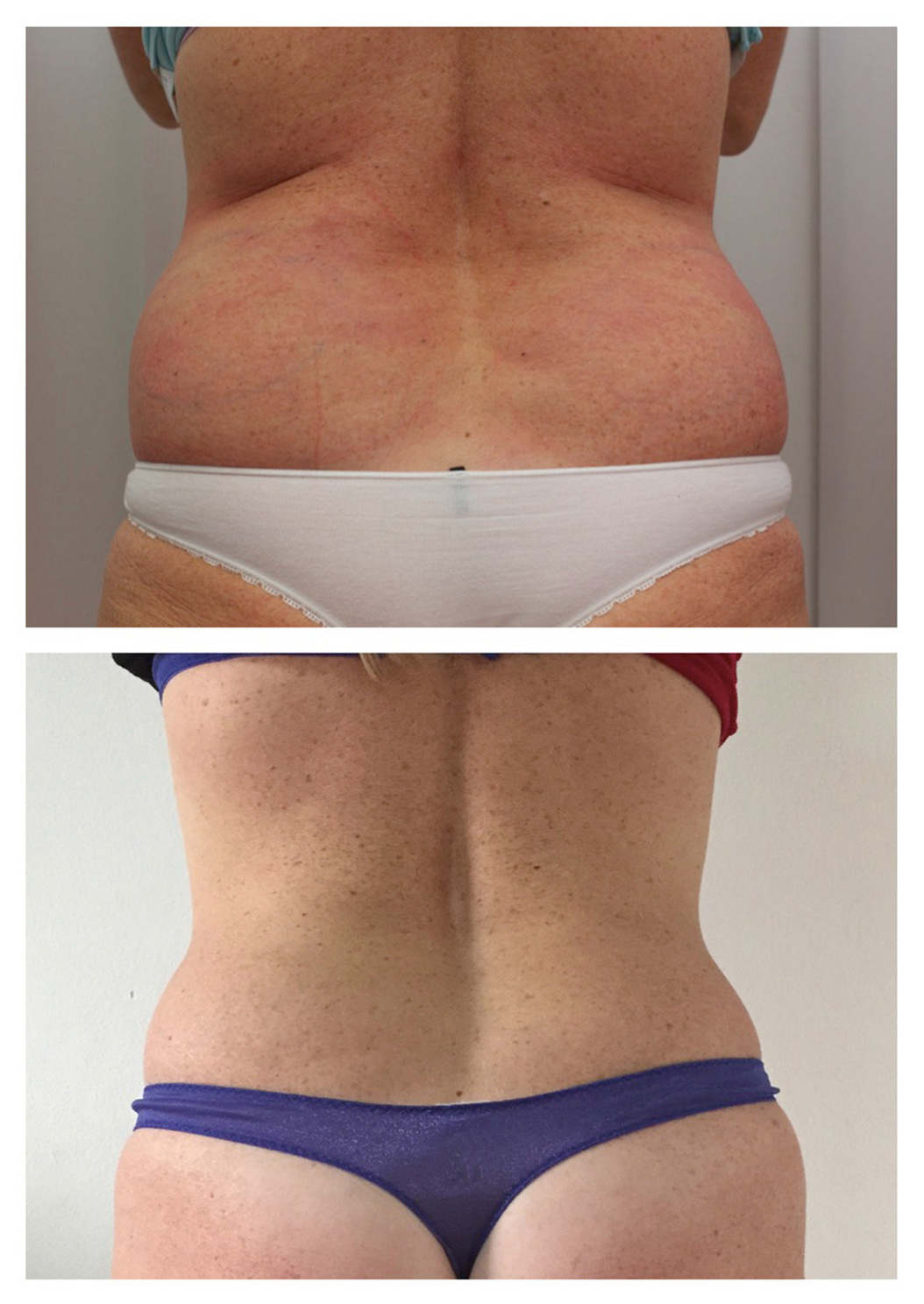Flank Contouring