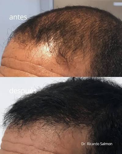 Antes y después