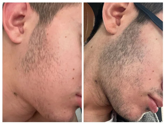 Antes y después — crecimiento de barba