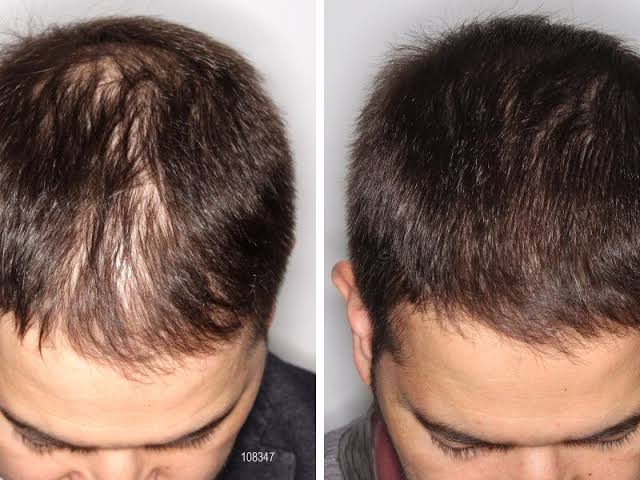 Antes y después — recuperación capilar