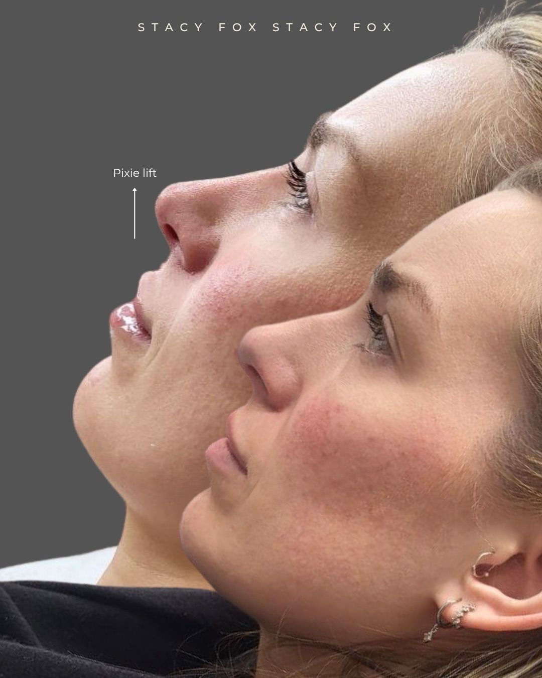 Dermal Filler