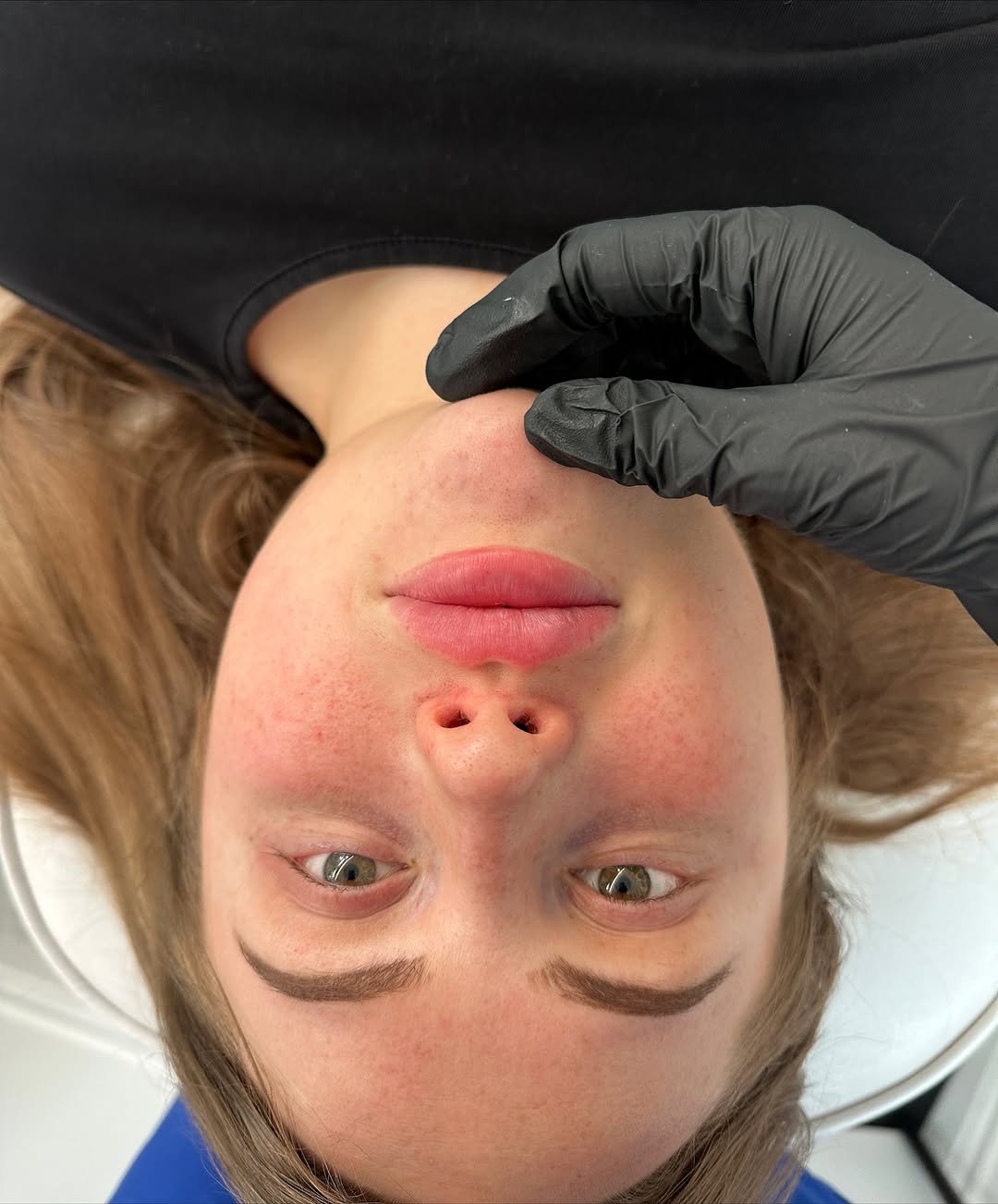 Lip Enhancement