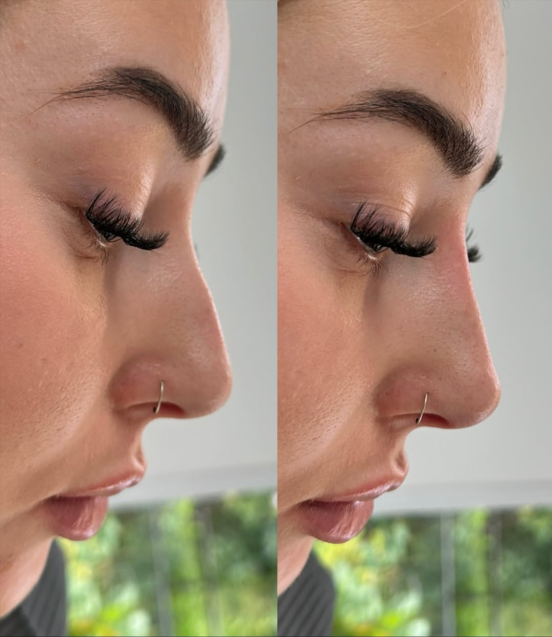 Skin Rejuvenation