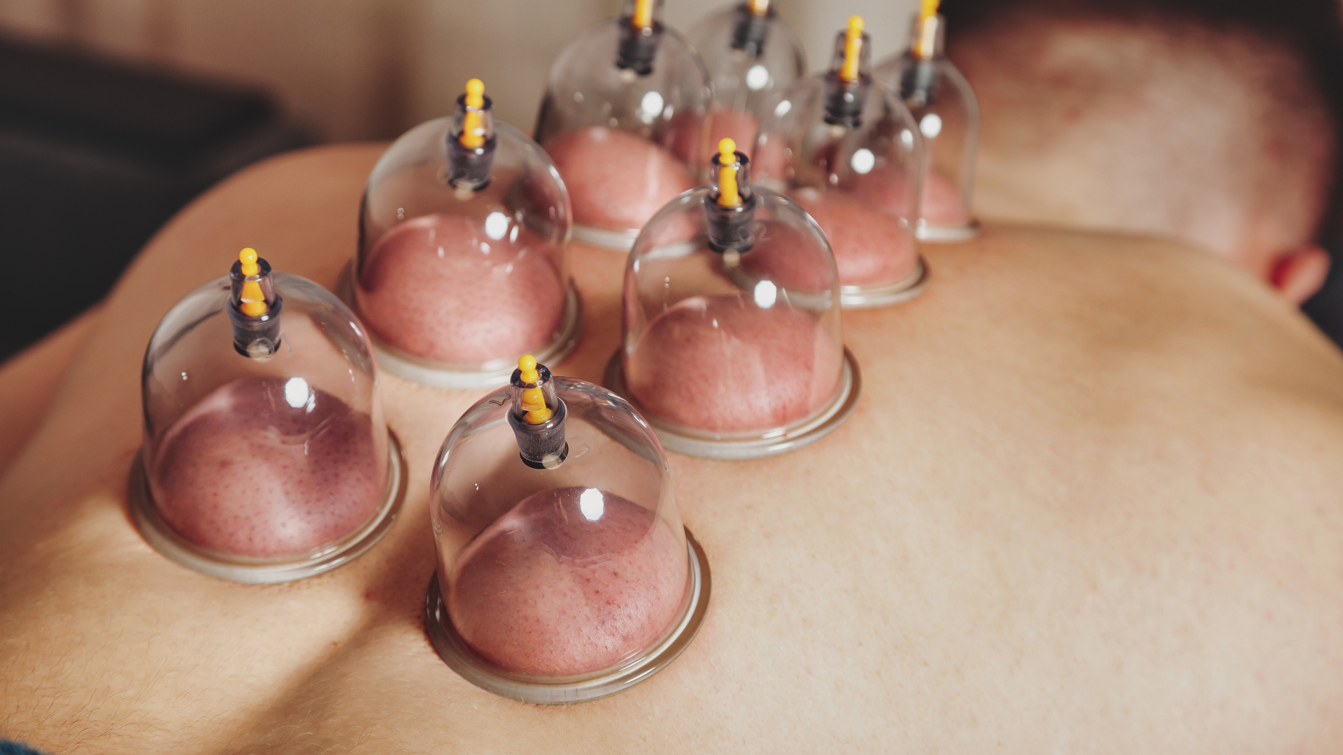 Cupping Therapy: What It Is and Who It May Help