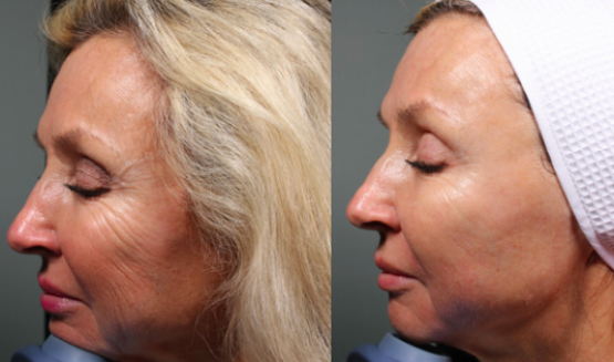 HIFU skin tightening results Fulham London