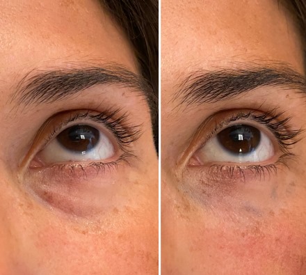 Vitaran Eyes under-eye regeneration before and after, Fulham London Polynucleotides under eyes results Fulham London: Vitaran Eyes before and after regeneration showing improved dark circles and skin quality