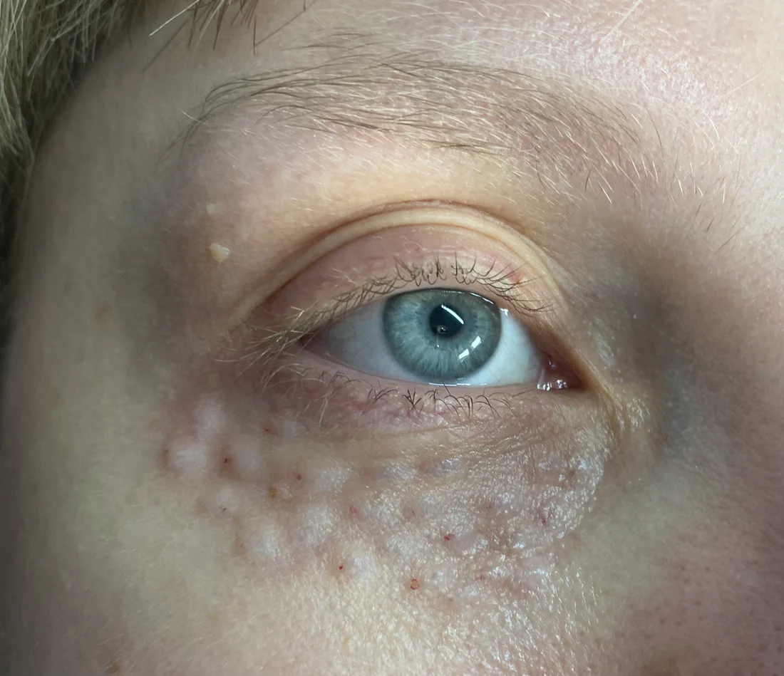 Vitaran Eyes under-eye close-up, Fulham London Crepey under-eye skin improvement with Vitaran Eyes polynucleotide treatment South West London