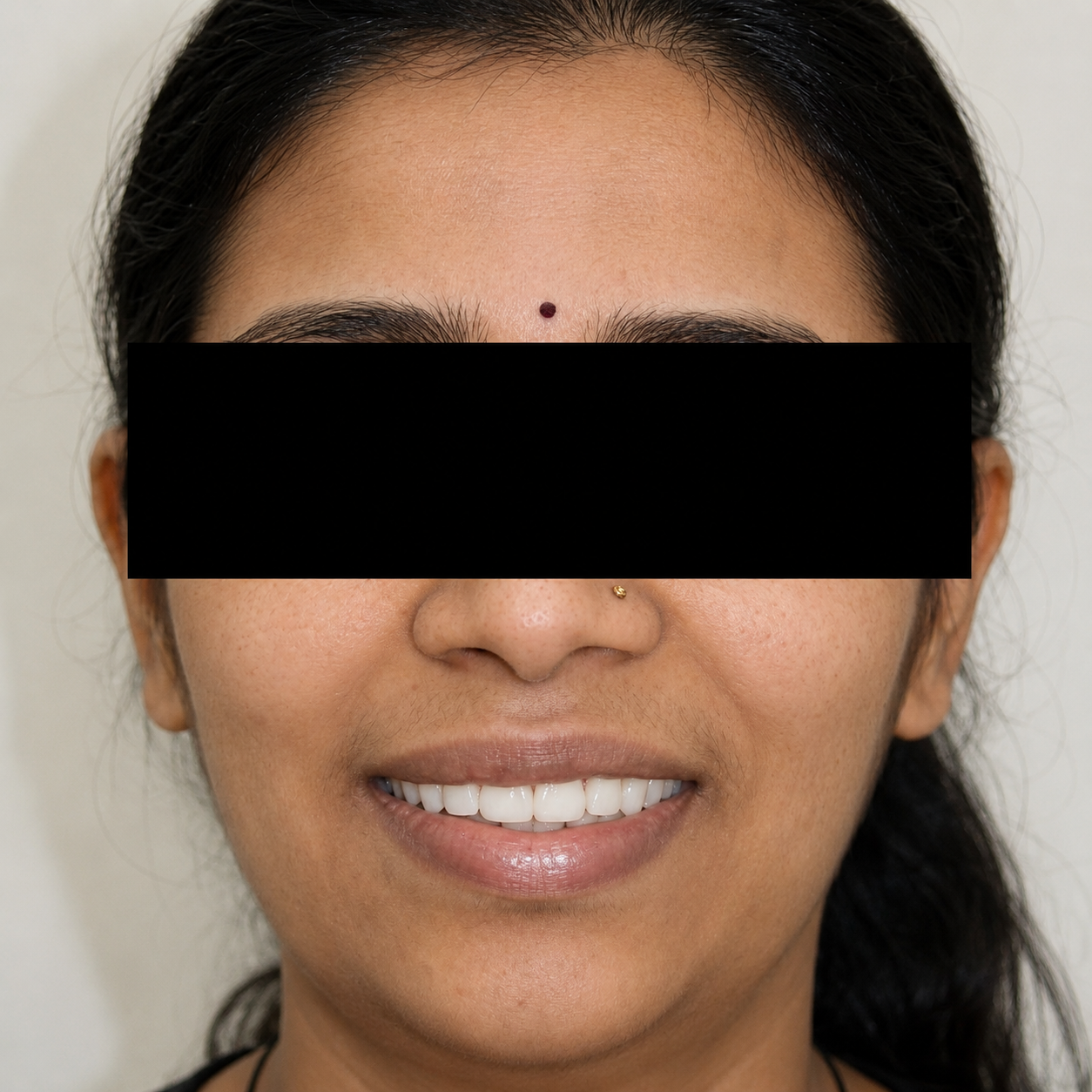 Veneer Transformation - After