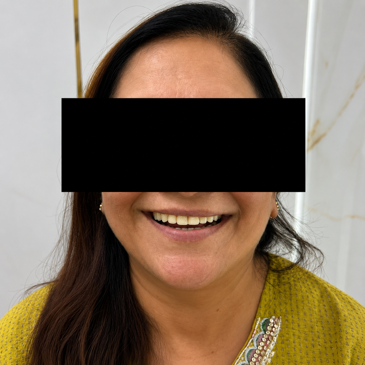 Aesthetic Smile Designing - After