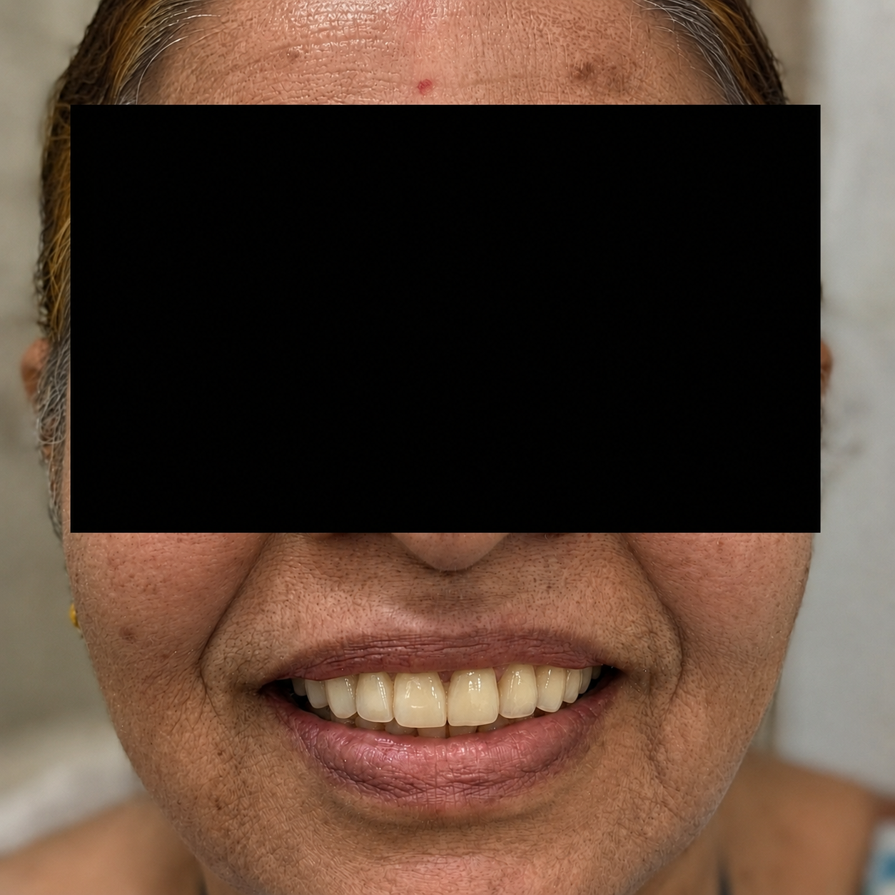 Full Mouth Rehabilitation - After