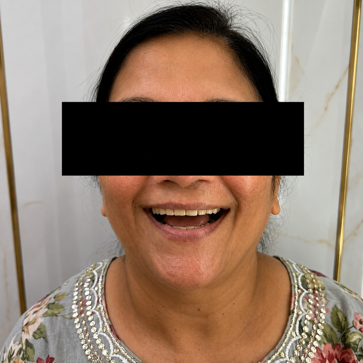 Aesthetic Smile Designing - Before