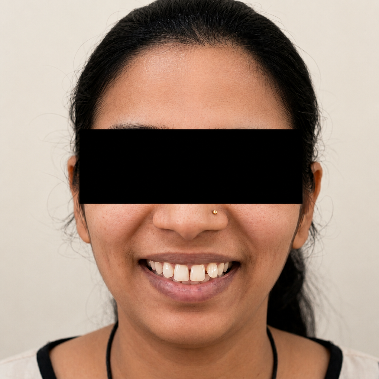 Veneer Transformation - Before