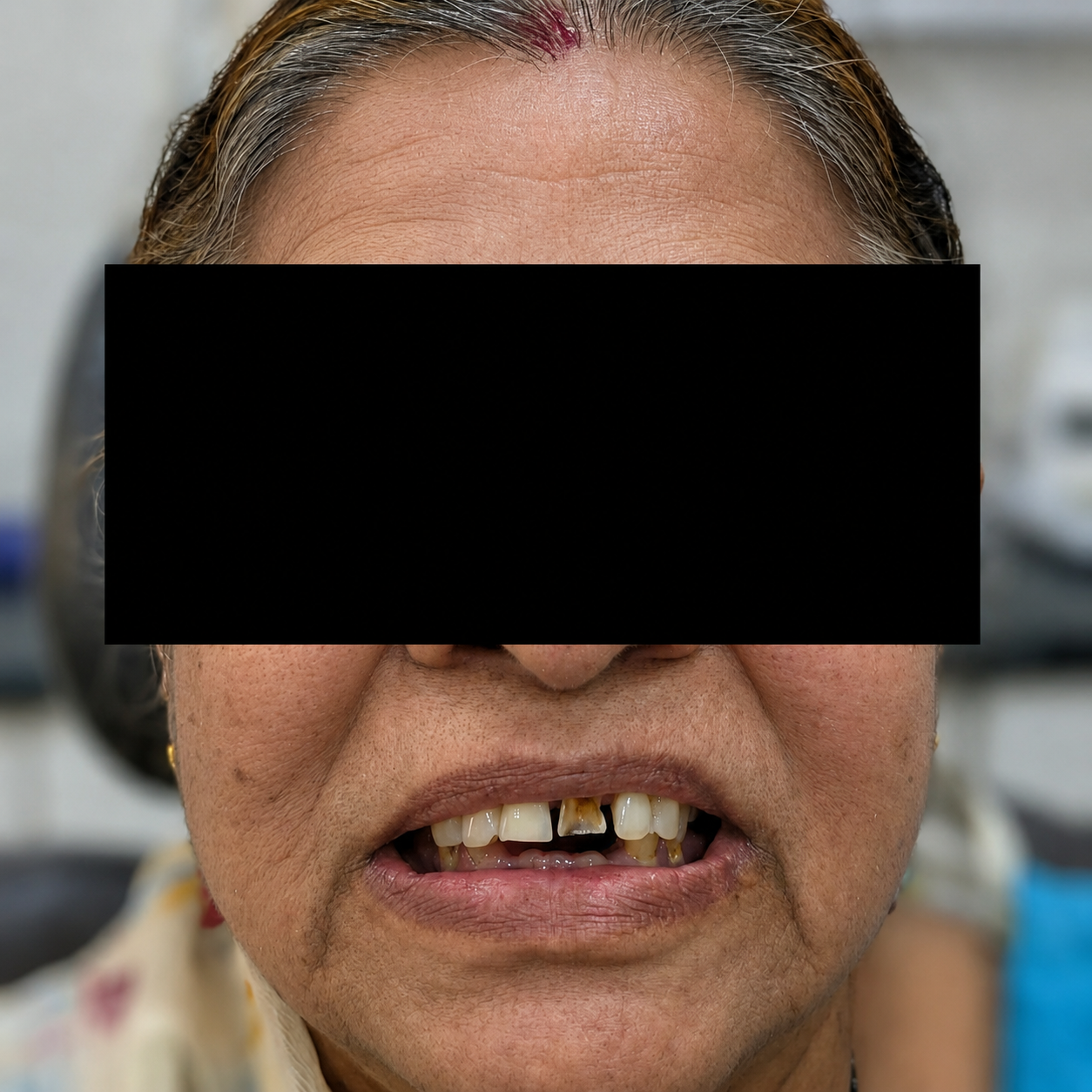 Full Mouth Rehabilitation - Before