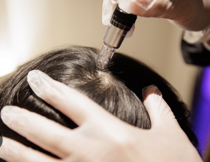Microneedling Scalp Therapy