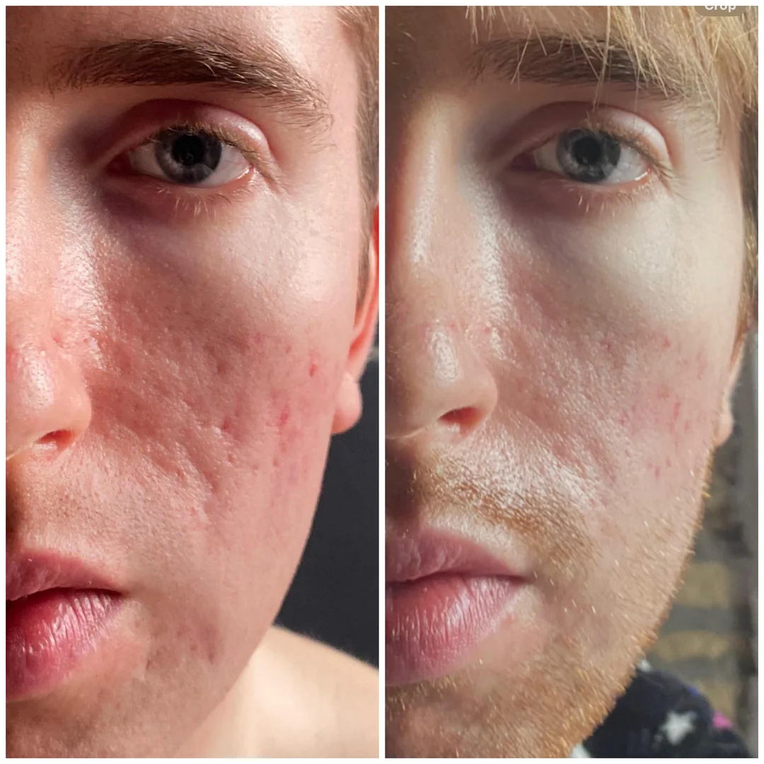 Polynucleotides acne scarring before and after Fulham London