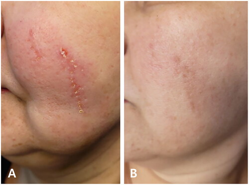 Atrophic acne scar polynucleotide injection Georgina Sookias