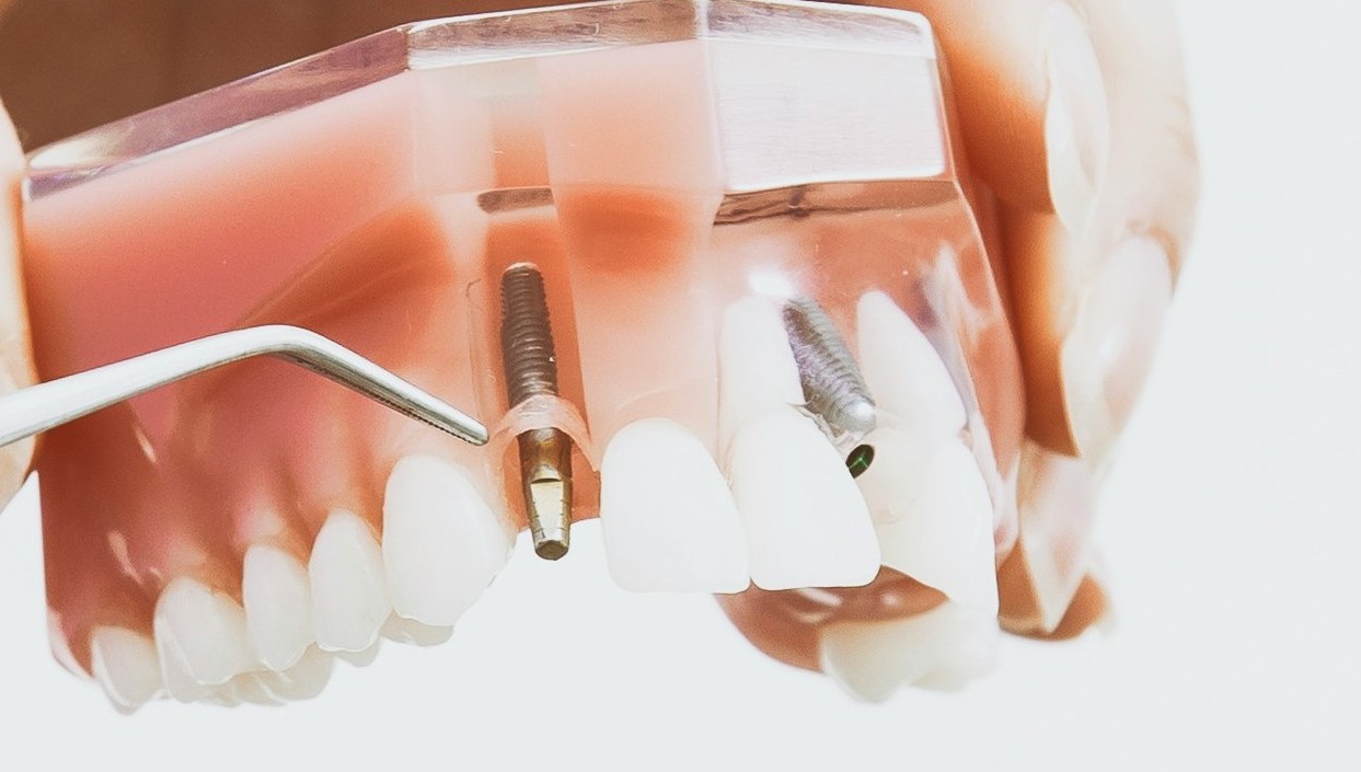 Dental Implants
