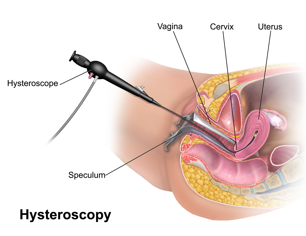 Hysteroscopy 2